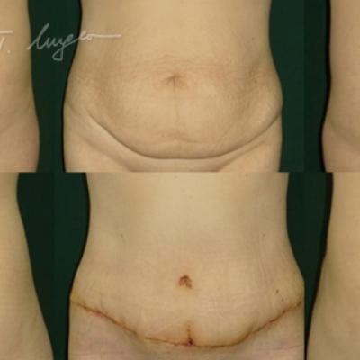 Abdominoplastie Cu Plicatura Aponevrozei Dreptilor Abdominali 1 21