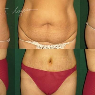 Abdominoplastie Cu Plicatura Aponevrozei Dreptilor Abdominali 2 1 2