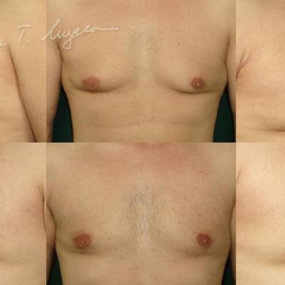 Lipoaspiratie