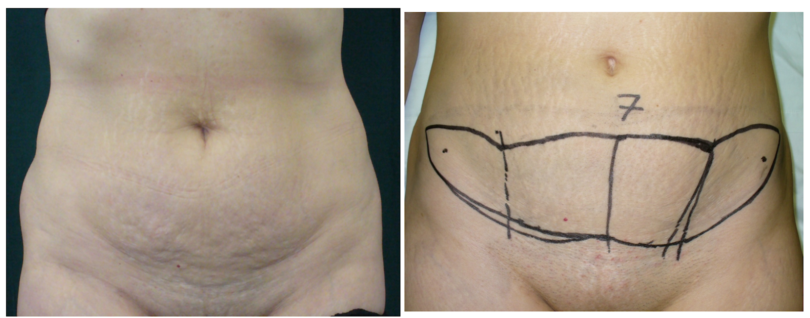 interventia de miniabdominoplastie - dr. Toma Mugea