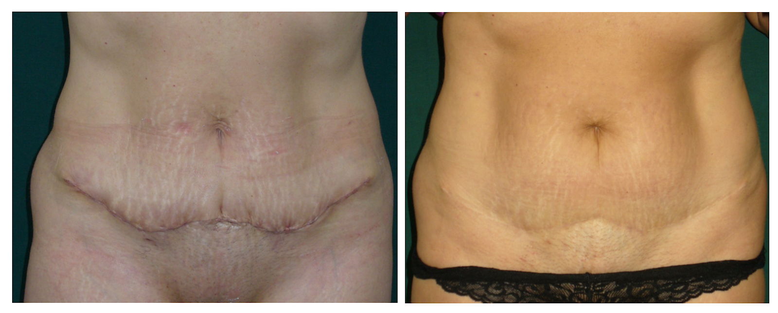 miniabdominoplastie - dr. Toma Mugea