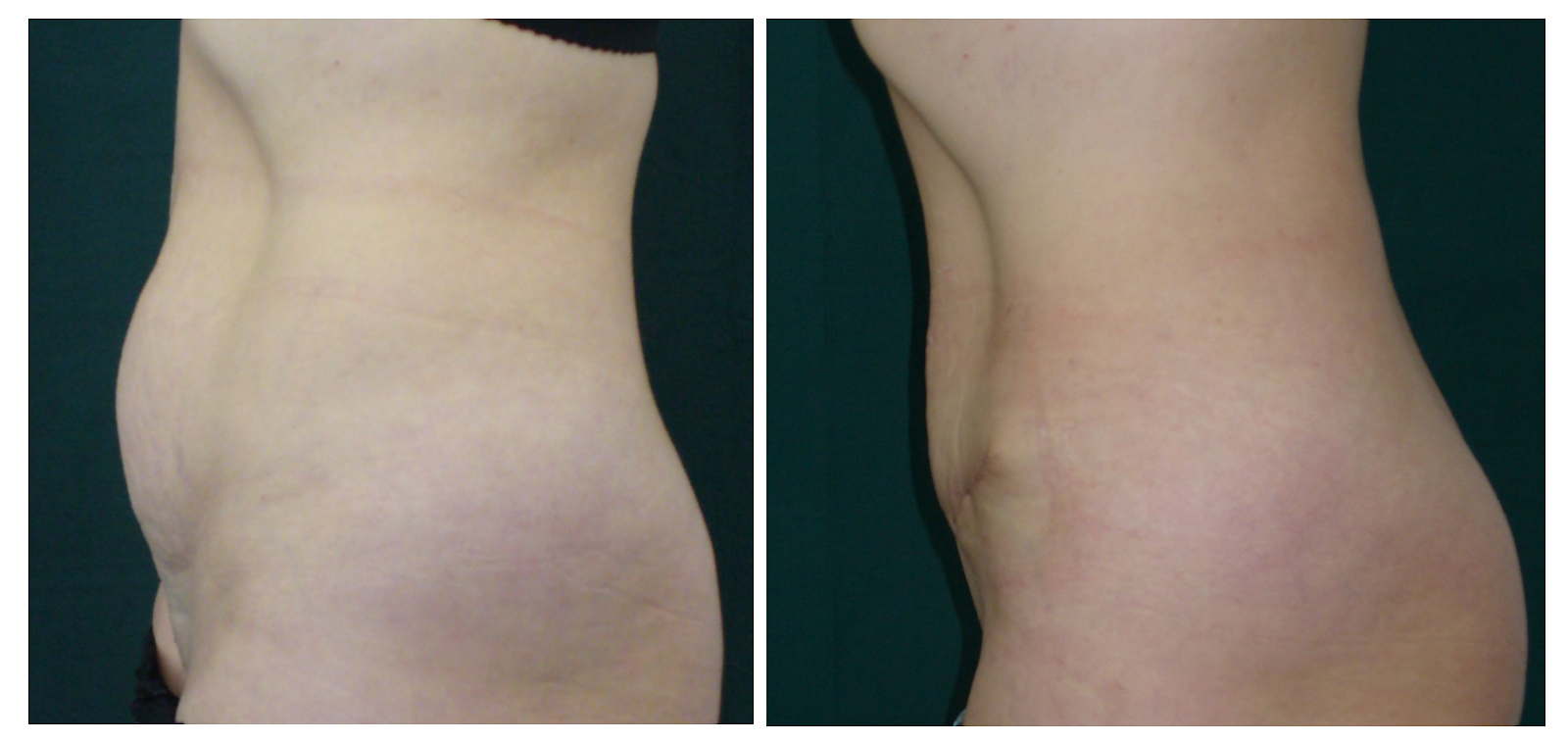 miniabdominoplastie - dr. Toma Mugea